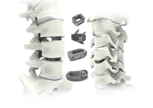 Trauhui Interbody Fusion Cage-3D bosilgan qafas tizimlari