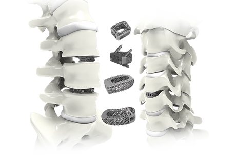 Trauhui Interbody Fusion Cage — напечатанные на 3D-принтере клеточные системы