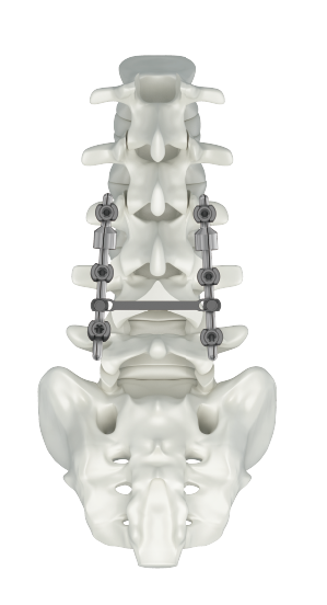 System zur hinteren Wirbels&auml;ulenfixierung – CSS 