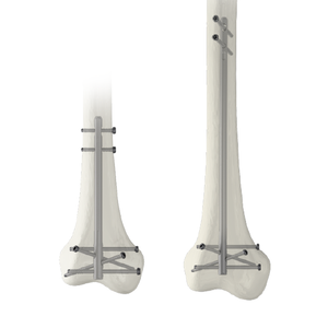 Ramic Intramedullary Nail System-Distal Femoral Nail