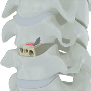 Trauhui interbima fusione Cage -Coales AC