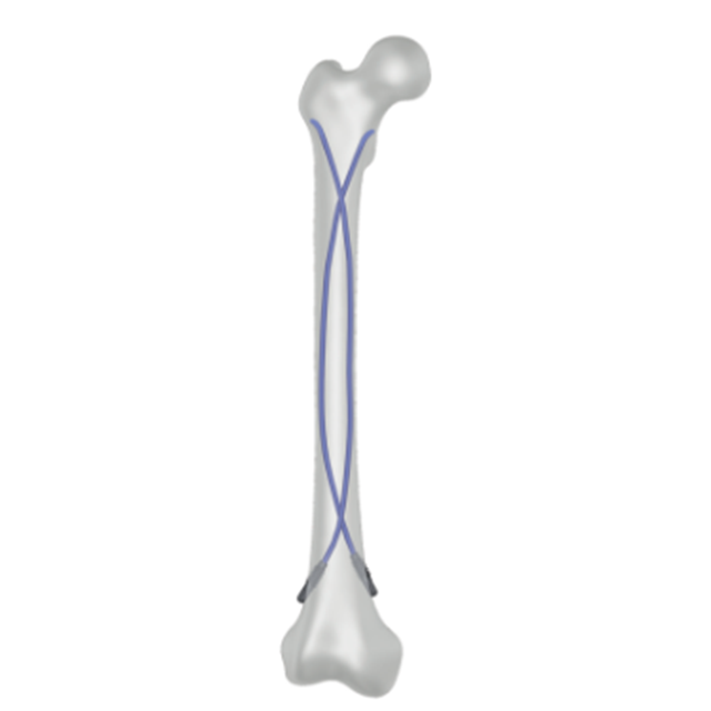 Ramic Elastic Nail System-Elastik Nail