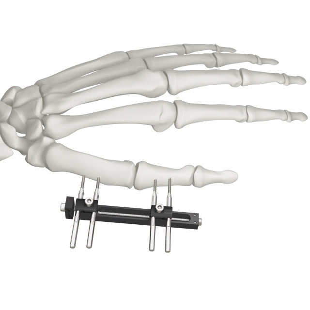 دعم التثبيت الخارجي Trauhui Titan-Fix