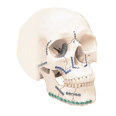 Medtrix Craniomaxillofacialis System