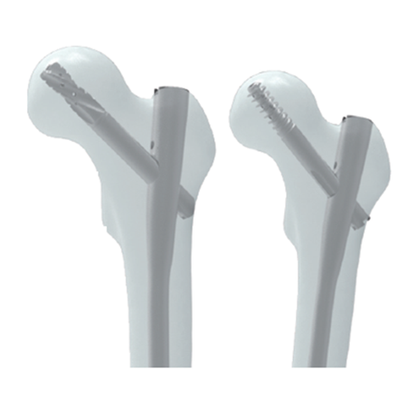 Ramic intramedullare clavus systematis-proximalis femoris NailⅡ