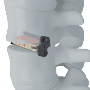 Trauhui Interbody Fusion Cage -Coales XL( XLIF)