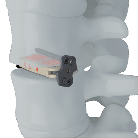 Клетка Trauhui Interbody Fusion Cage - Coales XL( XLIF )