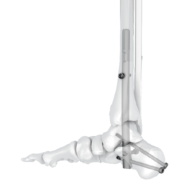 Ramic intramedullary kuko system-ankle arthrodesis kuko