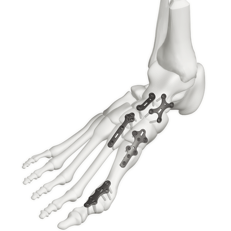 Cottey-MD Anglus Variabilis Obstructio Plate System