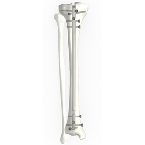 Ramic intramedullary nail system-Tibial Nail