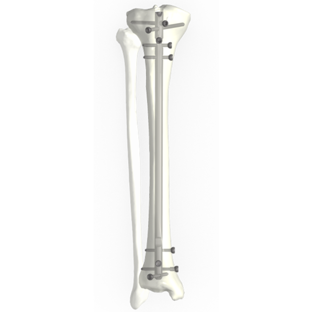 Ramic intramedullary тырнақ жүйесі-Tibial Nail