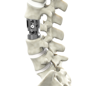 Circumsapicos Telescopic Corpectomy Ratio-Corpectomy
