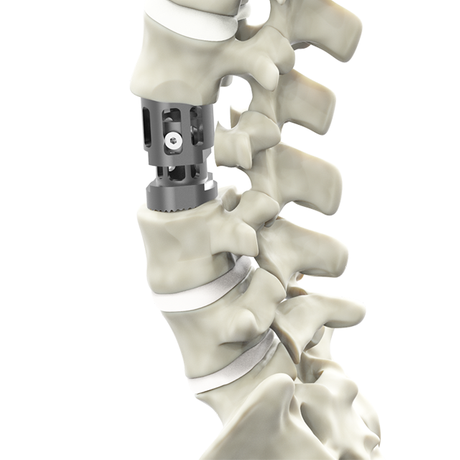 Coapt Telescopic Corpectomy system-Corpectomy