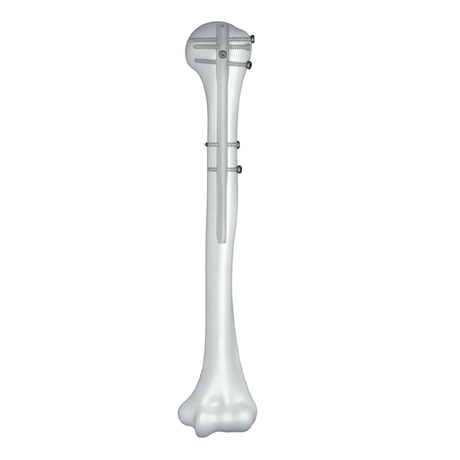 Ramic intramedullaris systema clavus humerale-Nail